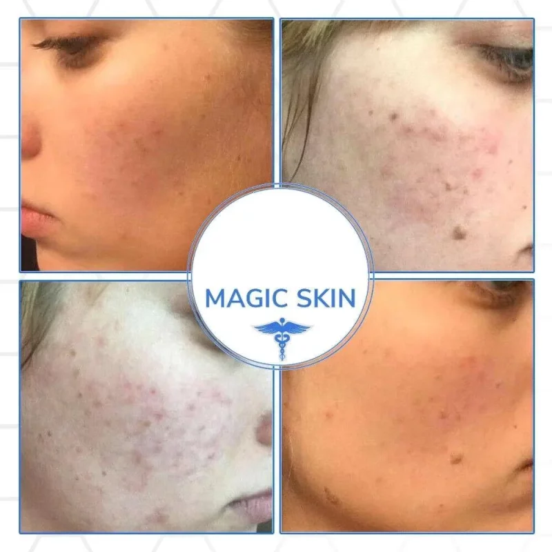 Glycolic Acid Peel before and after results