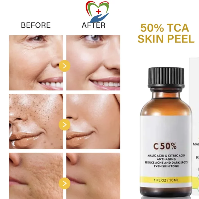 Chemical Peel before and after